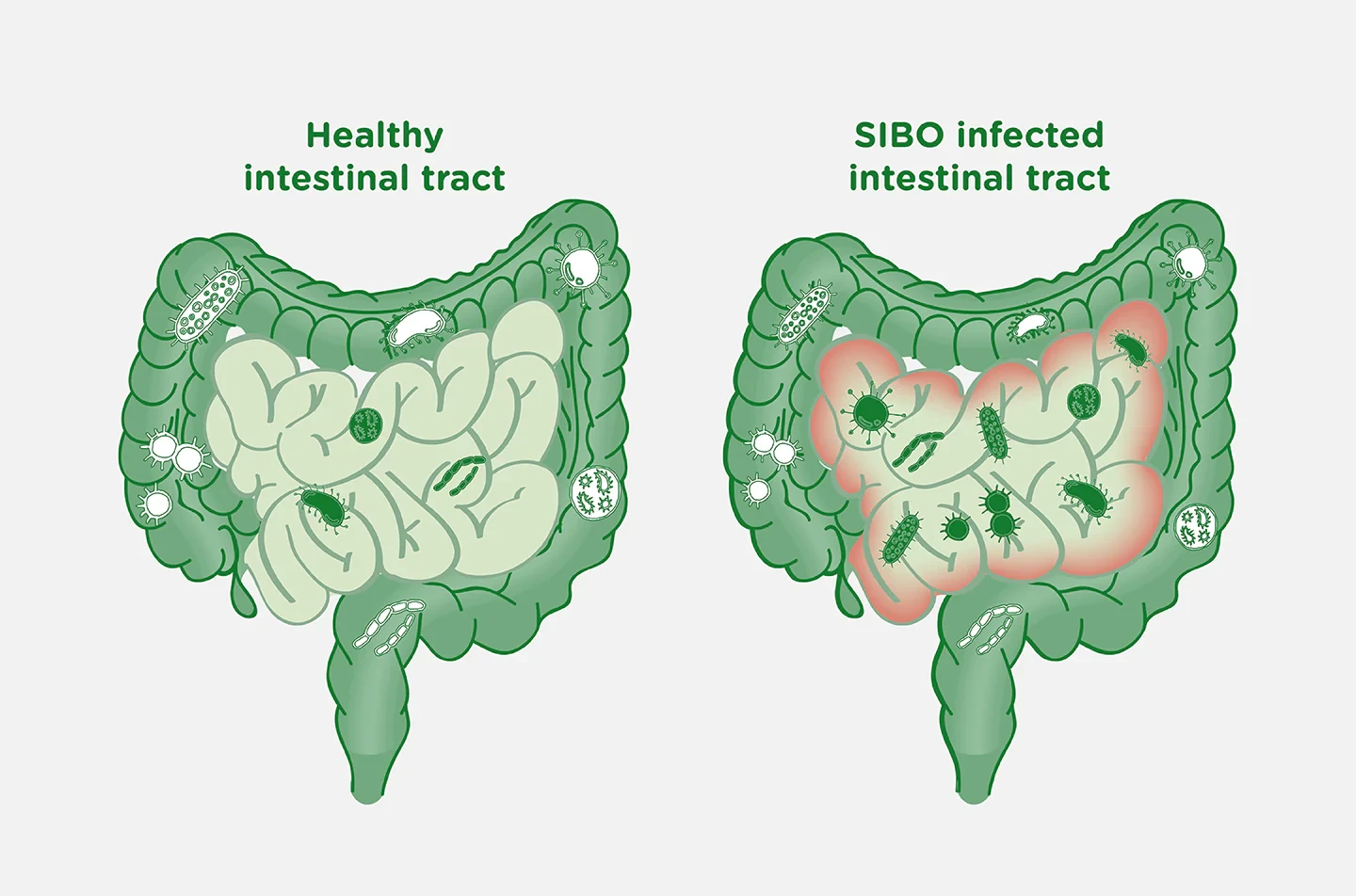 Illustration comparing a healthy intestinal tract with a SIBO infected intestinal tract
