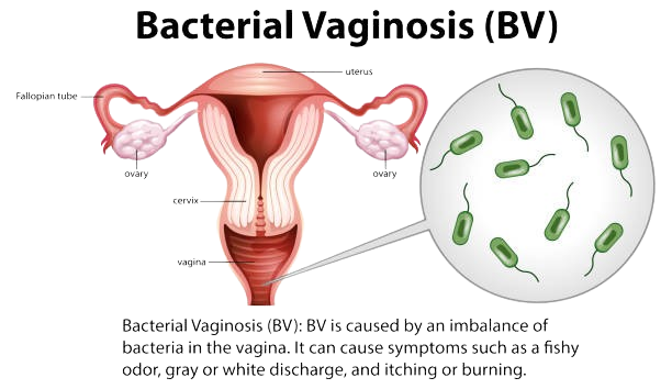 Bacterial Vaginosis anatomical diagram showing the uterus, ovaries, cervix, and vagina with a magnified view of the bacteria responsible for BV